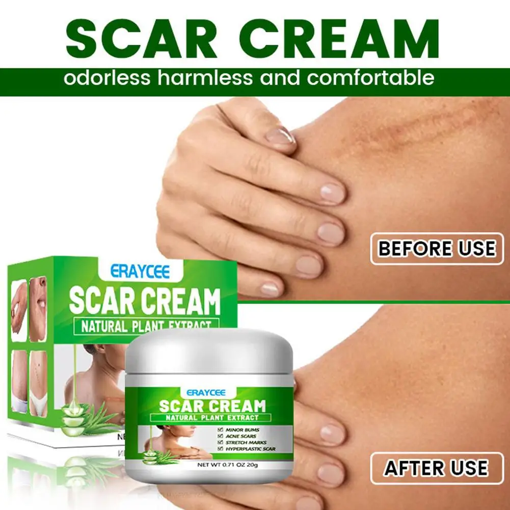 20g Aloe Scar Removal Cream Acne Scar Spot Removal Care Skin Cream Blemish Gel Face Cream Repair Burn Treatment T7D1
20g Aloe Scar Removal Cream Acne Scar Spot Removal Care Skin Cream Blemish Gel Face Cream Repair Burn Treatment T7D1