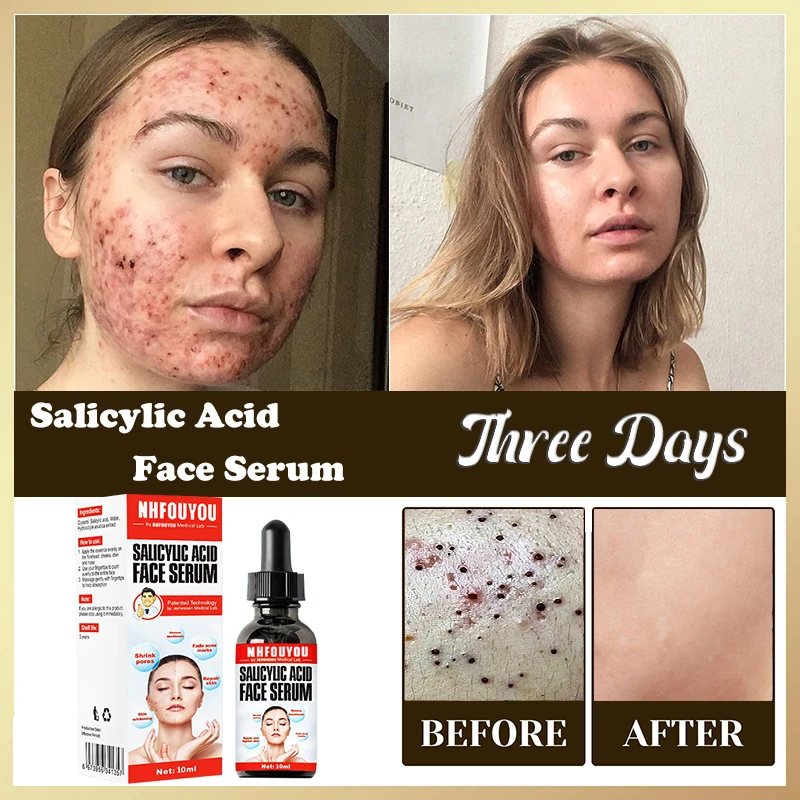 

Salicylic Acid Solution Essence 10mL Shrink pores and Acne Spot Removing Shrink Pores Oil-Control Brighten Face Skin Makeup