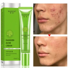 Effective Acne Removal Cream Face Acne Treatment Fade Spots Oil Control Shrink Pores Whitening Moisturizing Skin Care Cream
Effective Acne Removal Cream Face Acne Treatment Fade Spots Oil Control Shrink Pores Whitening Moisturizing Skin Care Cream