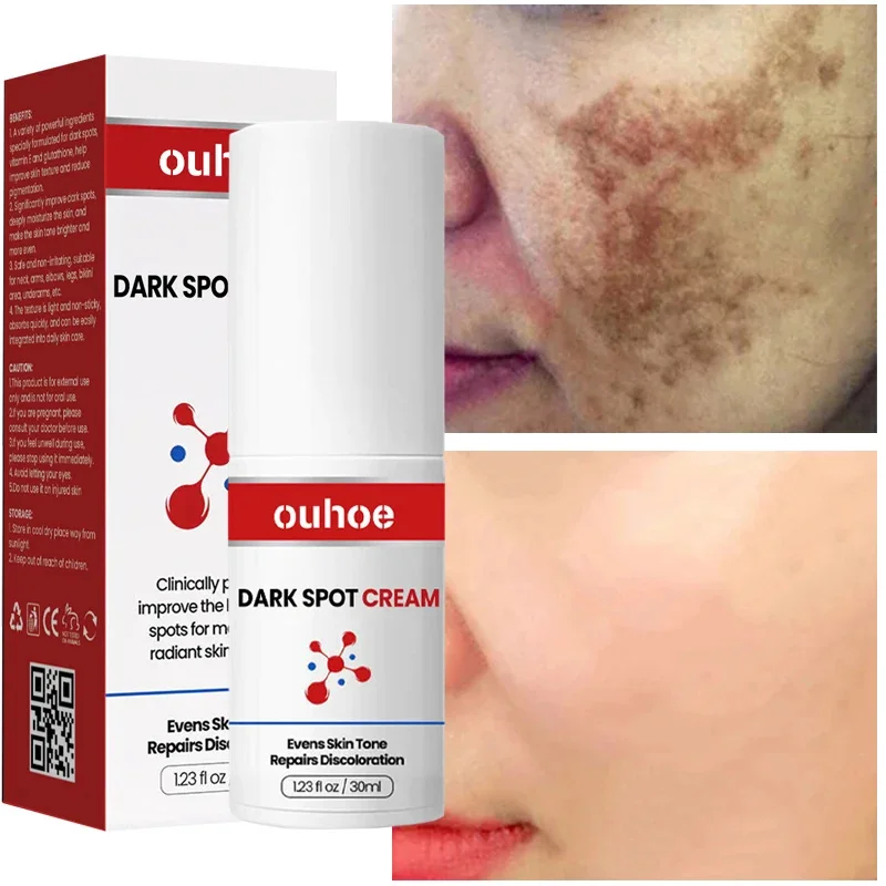 Freckle Whitening Cream Black Dots Melasma Remover Anti Brown Stain Lighten Pigmentation Moisturizing Korean Skin Care Products
Freckle Whitening Cream Black Dots Melasma Remover Anti Brown Stain Lighten Pigmentation Moisturizing Korean Skin Care Products
