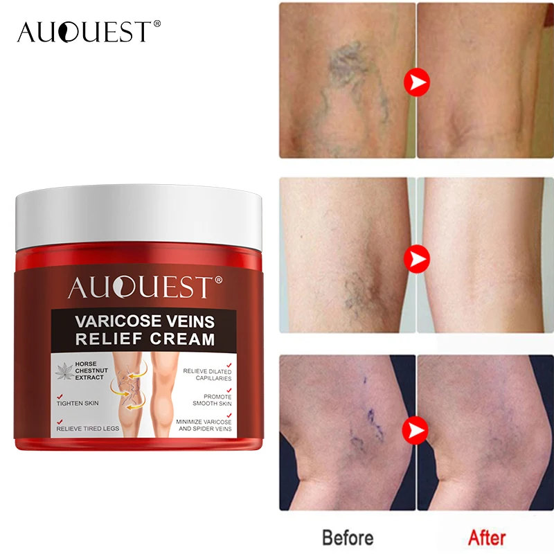 AUQUEST Varicose Veins Treatment Cream Relieve Tired Legs Dilated Vasculitis Phlebitis Spider Pain Relief Ointment Body Care 80g
AUQUEST Varicose Veins Treatment Cream Relieve Tired Legs Dilated Vasculitis Phlebitis Spider Pain Relief Ointment Body Care 80g