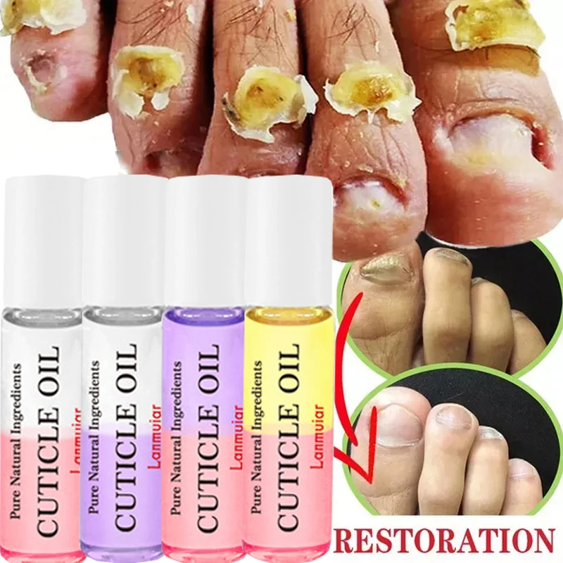 

Сыворотка для лечения грибка ногтей восстановление ног жидкое масло для удаления грибка ногтей против инфекции крем для паронихии онихомикоза 10 мл
