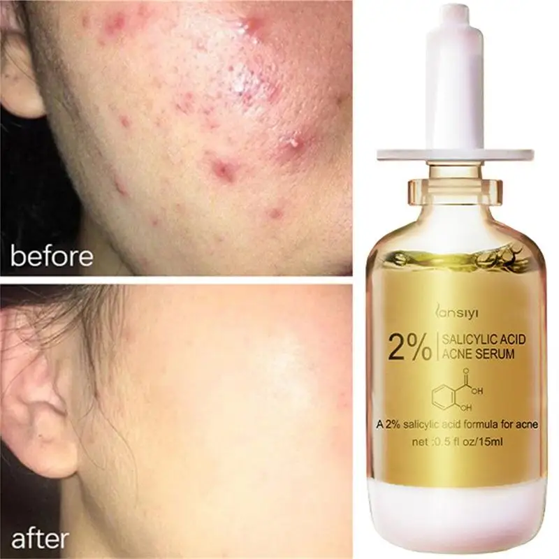 2% Solution Salicylic Acid Serum Effective Acne Treatment Pot Removing Shrink Pores Oil-Control Brighten Face Skin Care 15ml
2% Solution Salicylic Acid Serum Effective Acne Treatment Pot Removing Shrink Pores Oil-Control Brighten Face Skin Care 15ml