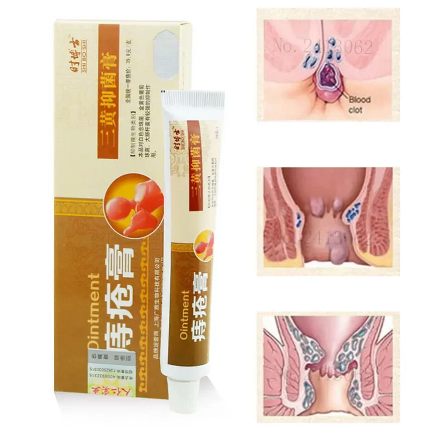 Powerful Hemorrhoids Ointment External Hemorrhoids,Internal,Mixed Hemorrhoids 1Pcs
Powerful Hemorrhoids Ointment External Hemorrhoids,Internal,Mixed Hemorrhoids 1Pcs