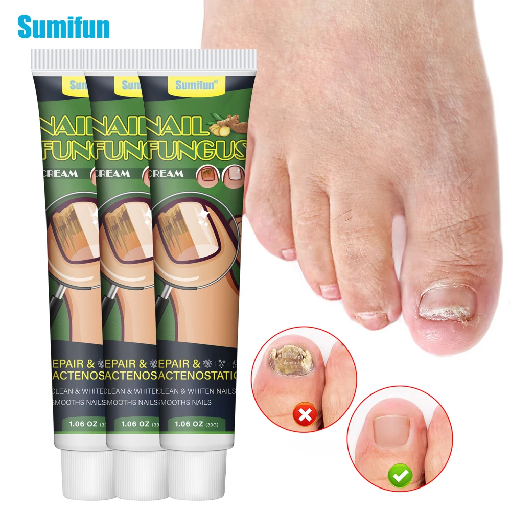 

1/3Pcs Sumifun Nail Fungus Cream Toe Finger Antifungal Repair Ointment Treat Onychomycosis Paronychia Antibacterial Plaster 30g