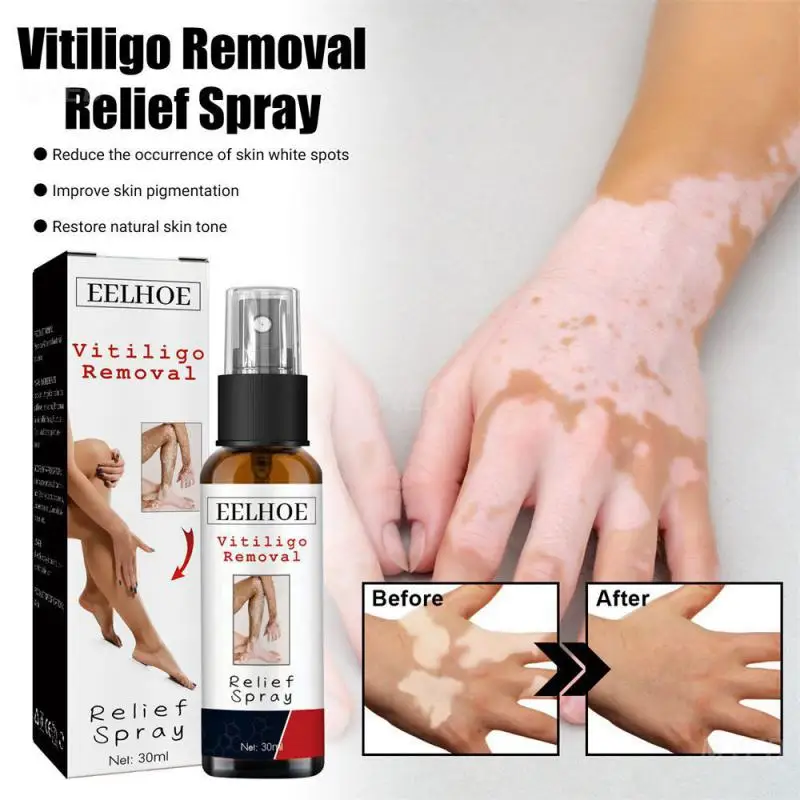 Vitiligo Spray Remove Ringworm Eliminate Sweat Spots Lighten White Spot Removal Leukoplakia Treatments Repair Skin Care Liquid
Vitiligo Spray Remove Ringworm Eliminate Sweat Spots Lighten White Spot Removal Leukoplakia Treatments Repair Skin Care Liquid