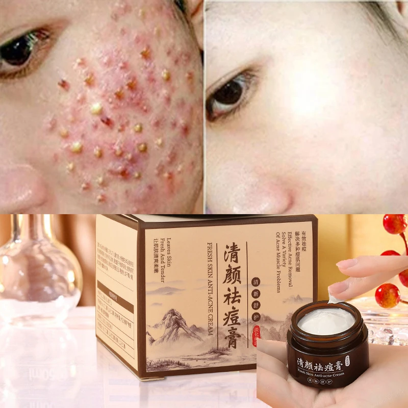 Herbal Acne Face Cream Salicylic Acid Pore Oil Control Moisturizing Facial Cream Acne Treatment Repairing Cream Skin Care
Herbal Acne Face Cream Salicylic Acid Pore Oil Control Moisturizing Facial Cream Acne Treatment Repairing Cream Skin Care