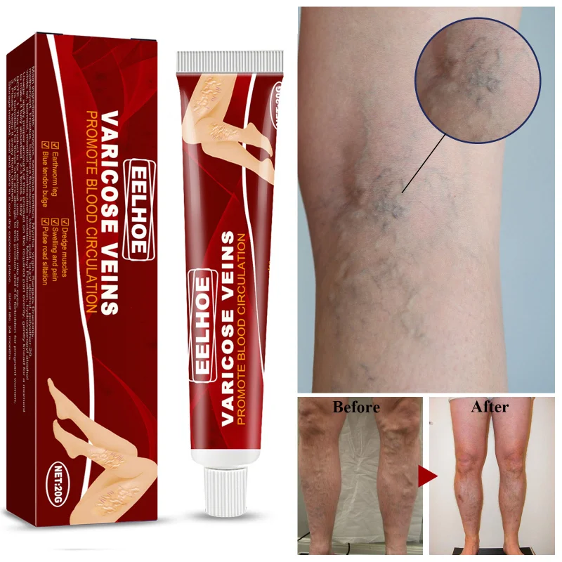 Effective Herbal Varicose Veins Relief Cream Vasculitis Phlebitis Spider Pain Relief Ointment Herb Plaster Beauty Body Care 20g
Effective Herbal Varicose Veins Relief Cream Vasculitis Phlebitis Spider Pain Relief Ointment Herb Plaster Beauty Body Care 20g