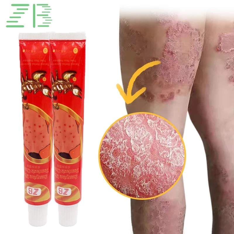 2pcs ZB Psoriasis Cream Dermatitis Eczema Ointment Treatment Scaly Plaques Psoriasis Tinea Pedis Relieve Itch Skin Care Cream
2pcs ZB Psoriasis Cream Dermatitis Eczema Ointment Treatment Scaly Plaques Psoriasis Tinea Pedis Relieve Itch Skin Care Cream