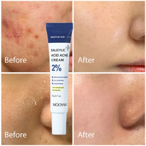 Salicylic Acid Acne Treatment Cream Acne Remover Face Cream Remove Deep Acne Scars Gel Oil Control Shrink Pores Blackheads New
Salicylic Acid Acne Treatment Cream Acne Remover Face Cream Remove Deep Acne Scars Gel Oil Control Shrink Pores Blackheads New