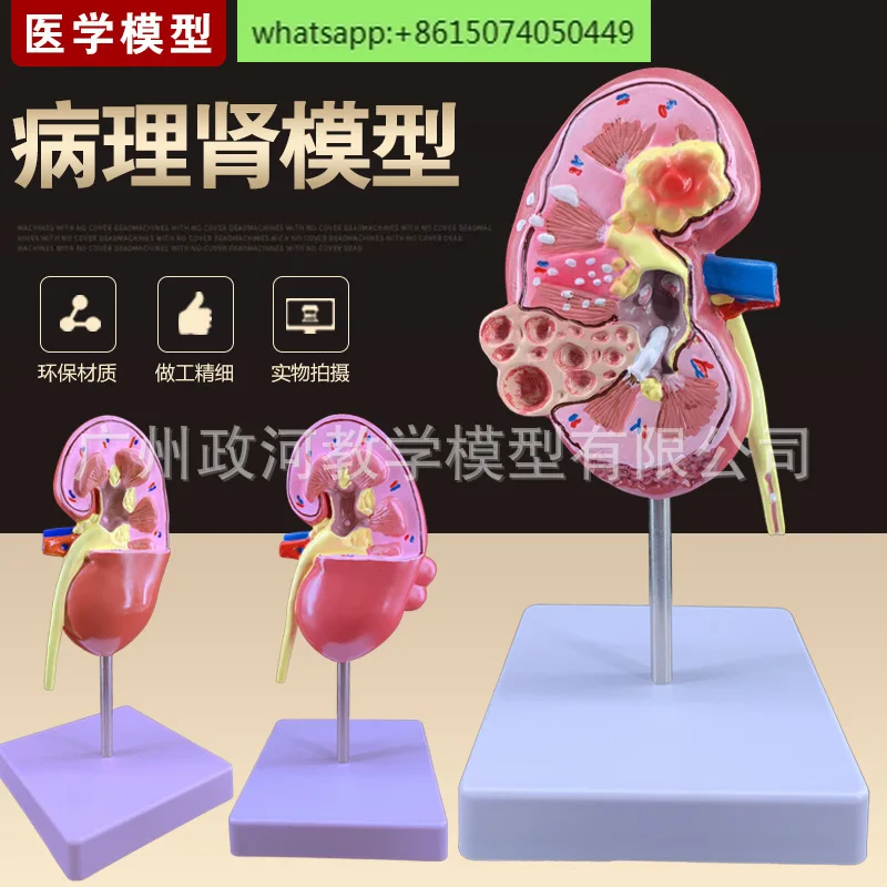 Teaching simulation pathological kidney model pathological kidney specimen renal anatomy model human anatomy model teaching aid
Teaching simulation pathological kidney model pathological kidney specimen renal anatomy model human anatomy model teaching aid