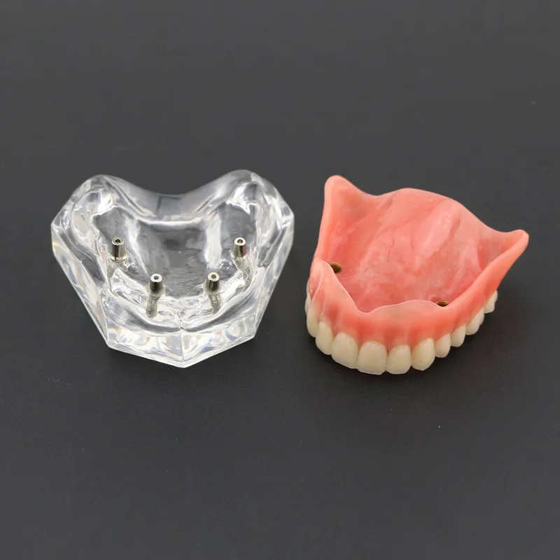 Implant Model Dental Upper Overdenture Superior 4 Implants Demo For Dental Clinic Patients Education Teaching 6001 1PC
Implant Model Dental Upper Overdenture Superior 4 Implants Demo For Dental Clinic Patients Education Teaching 6001 1PC