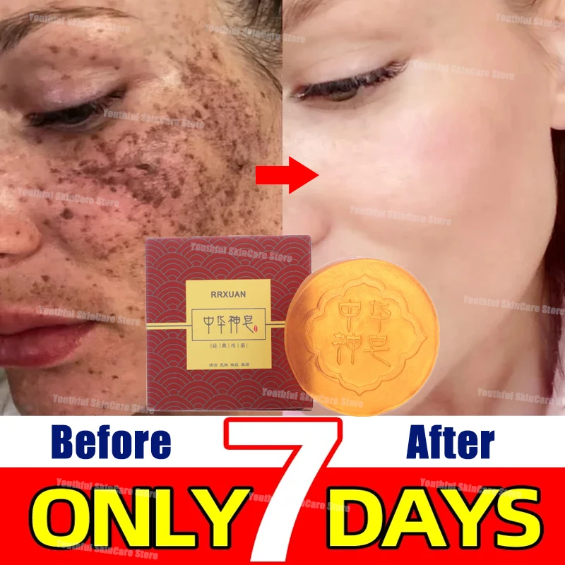 Whitening Freckle Soap Melasma Dark Spots Pigmentation Removal Products Underarm Knees Bleaching Body Brighten Korean Skin Care
Whitening Freckle Soap Melasma Dark Spots Pigmentation Removal Products Underarm Knees Bleaching Body Brighten Korean Skin Care