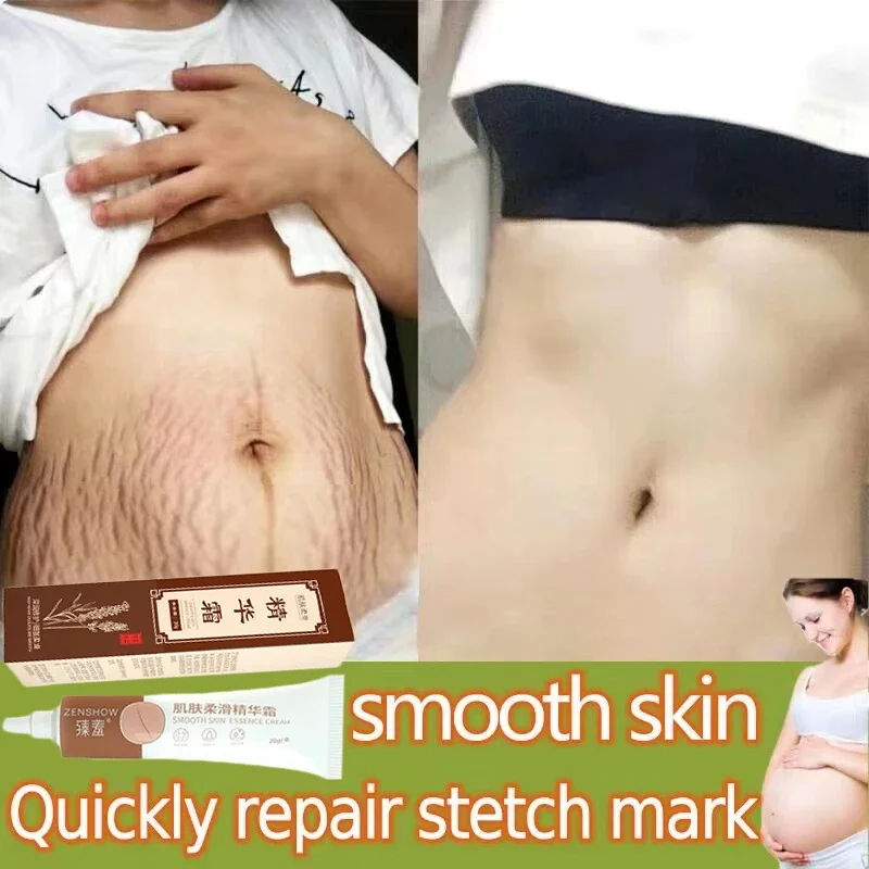 

Pregnant Scar Repair Cream Stretch Marks Removal Women Skin Care Acne Scars Remove Maternity Fat Striae Gravidarum Body Care