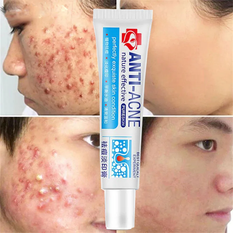 

New Powerful Acne Removal Face Cream Clears Pimple Scar Black Dots Gel Treat Severe Acne Shrink Pore Whiten Skin Care Ointment