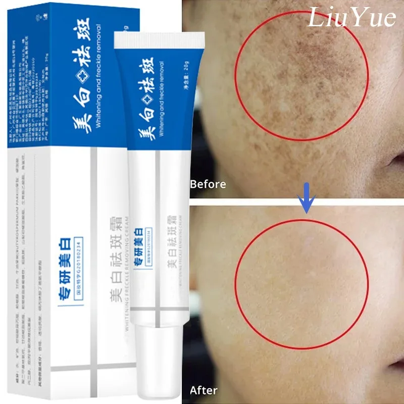 

Face Whitening Freckle Cream for Women Remove Melasma Lotion Brighten Lightening Dark Spots Serum Fade Melanin Freckles Products