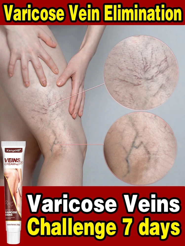 

Effective Varicose Vein Relief Cream Eliminate Vasculitis Phlebitis Spider Legs Treatment Soothing Relieve Pain Herbal Ointment