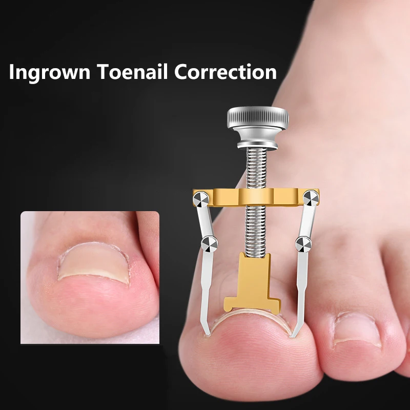 

1 Set Medical Ingrown Toenail Correction Brace Kit Professional Toe Nail Care Pedicure Manicure Clipper Fixer Recover Corrector