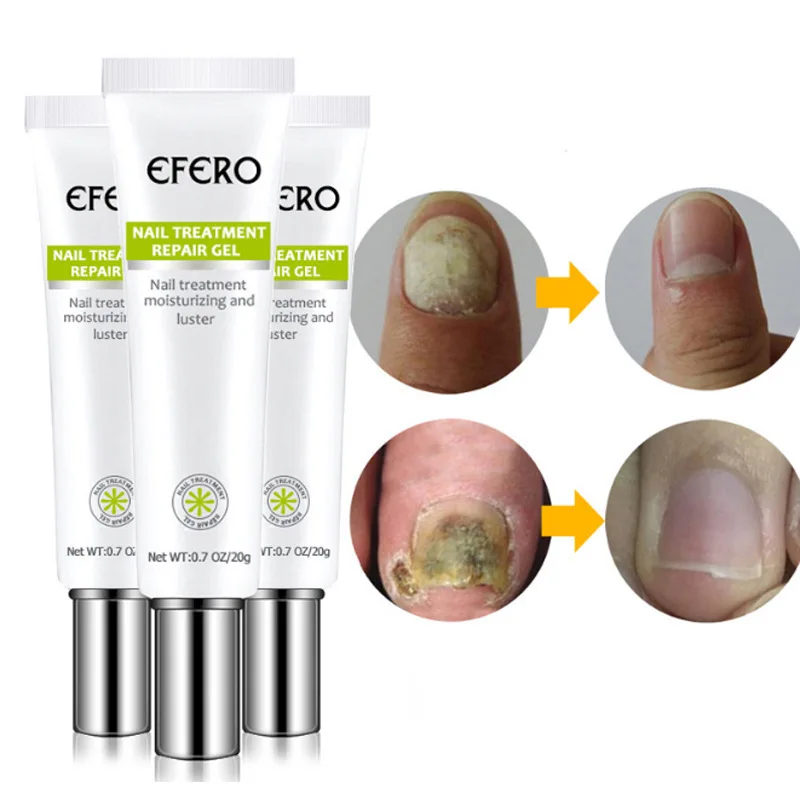 3pcs Nail Fungal Treatment Cream Nail Foot Nail Fungus Removal Gel Anti-Infection Serum Paronychia Repair Feet Care Ointment
3pcs Nail Fungal Treatment Cream Nail Foot Nail Fungus Removal Gel Anti-Infection Serum Paronychia Repair Feet Care Ointment