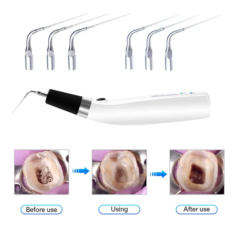 Dental Endo Ultra Activator Wireless Endodontic Ultrasonic Handpiece Dentistry Root Canal Instruments
Dental Endo Ultra Activator Wireless Endodontic Ultrasonic Handpiece Dentistry Root Canal Instruments
