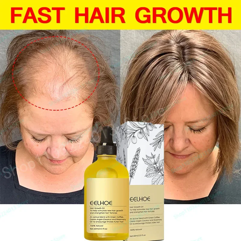 

Быстрое масло для роста волос, эффективное масло для роста волос, восстановление облысения, выпадение волос со временем после родов, против выпадения волос