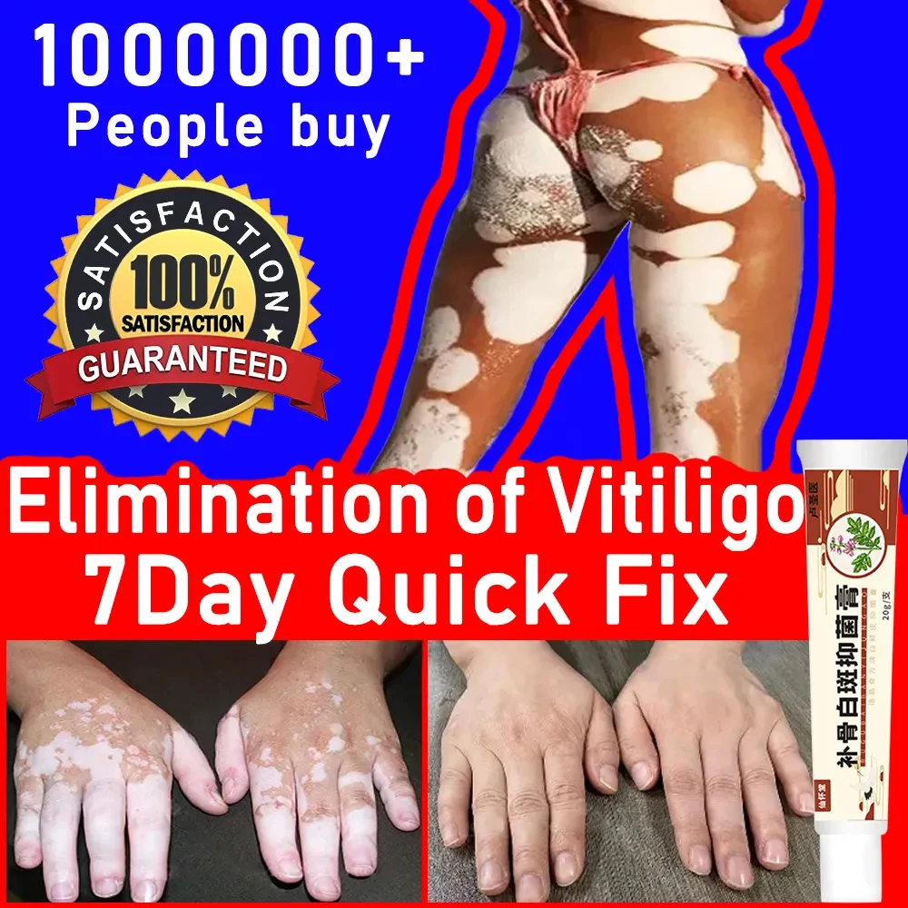 

Vitiligo Repair Cream Get Rid Of Ringworm White Spots Get Rid Of Skin Vitiligo Eliminate Vitiligo Better Body Skin