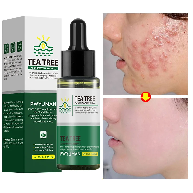 

Tea Tree Acne Treatment Face Serum Anti Pimples Acne Pit Repair Essence Pores Shrink Oil Control Soothing Moisturizing Skin Care