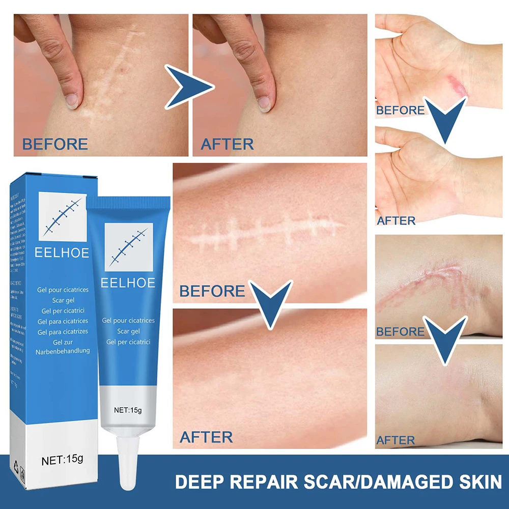 

2023 Scar Removal Cream Gel Remove Acne Spots Treatment Stretch Marks Burn Surgical Scar Repair Cream Smoothing Whitening Skin