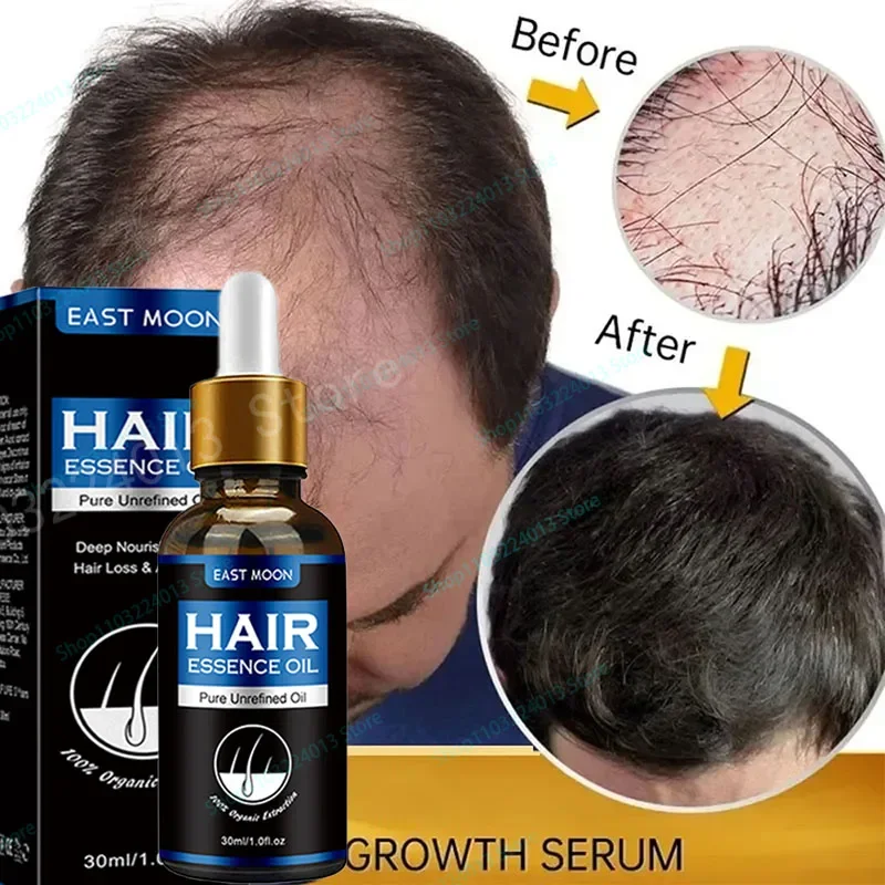 

Масло для роста волос унисекс, лечение выпадения волос, быстрый рост волос, эффективное облысение, восстанавливает стресс, после родов, повреждение кожи головы