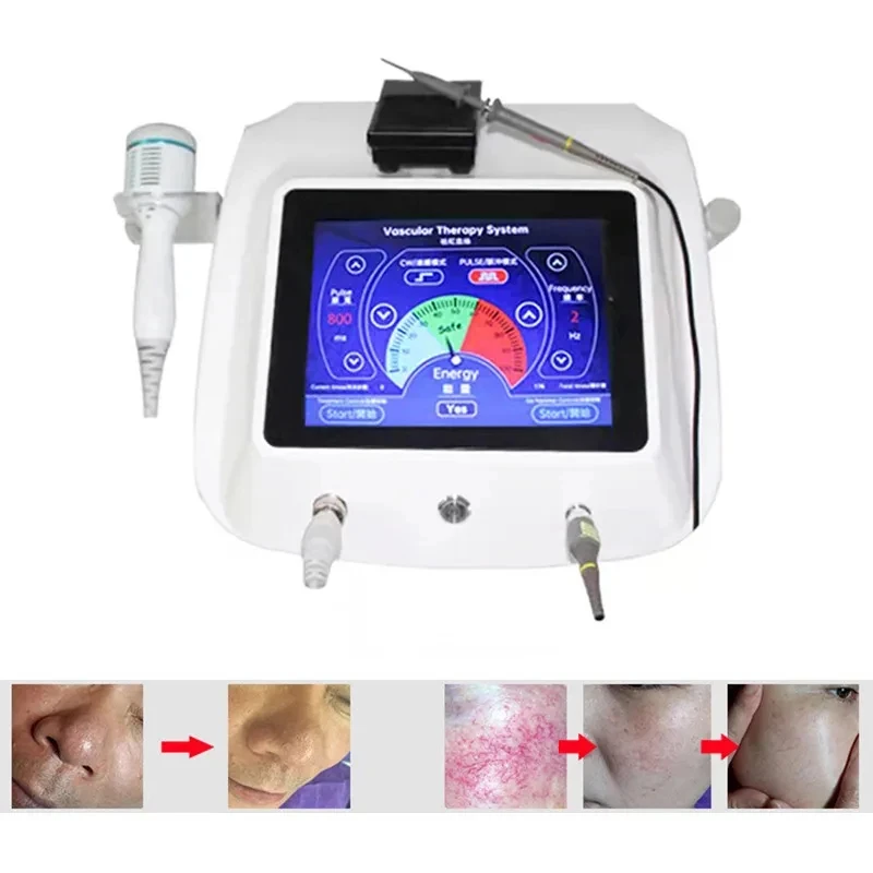 

High Frequency Needle RF Spider Veins Removal Anti Redness Machine Red Blood Vessel and Spots Vascular Removal Beauty Equipment
