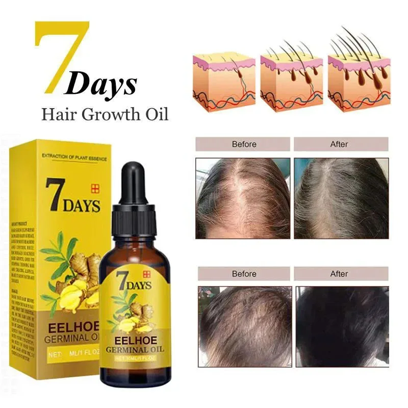 

Strong Effect Turmeric Hair Growth Products Ginger Essential Oil Treat Hair Loss Scalp Repair Nourish Hair Roots Regrowth