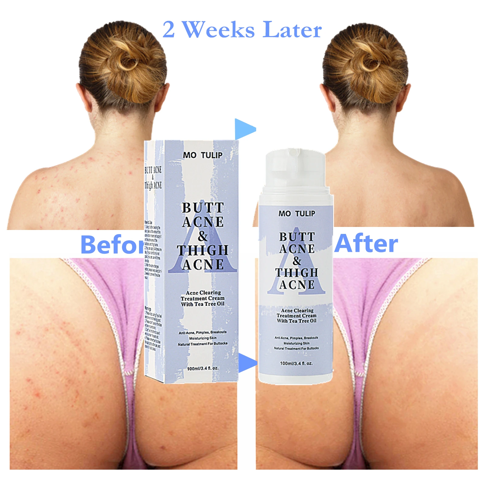 100ml Butt Acne Clearing Spot Treatment Cream Clears Acne Pimples Zits Razor Bumps and Dark Spot for the Buttocks and Thigh Area
100ml Butt Acne Clearing Spot Treatment Cream Clears Acne Pimples Zits Razor Bumps and Dark Spot for the Buttocks and Thigh Area