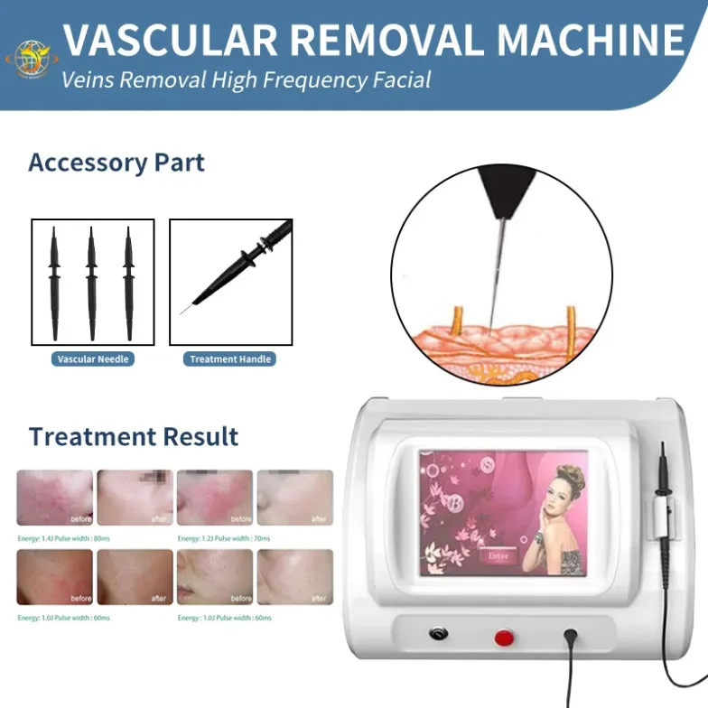 

High Frequency R-F Vascular Removal Machine Therapy Facial Tags Milia Warts Beauty Equipment