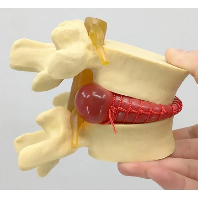 Anatomical Lumbar Disc Bulging Spine Lumbar Vertebrae Disc Herniated Model Anatomy Lumbar Disc Protrusion Model
Anatomical Lumbar Disc Bulging Spine Lumbar Vertebrae Disc Herniated Model Anatomy Lumbar Disc Protrusion Model