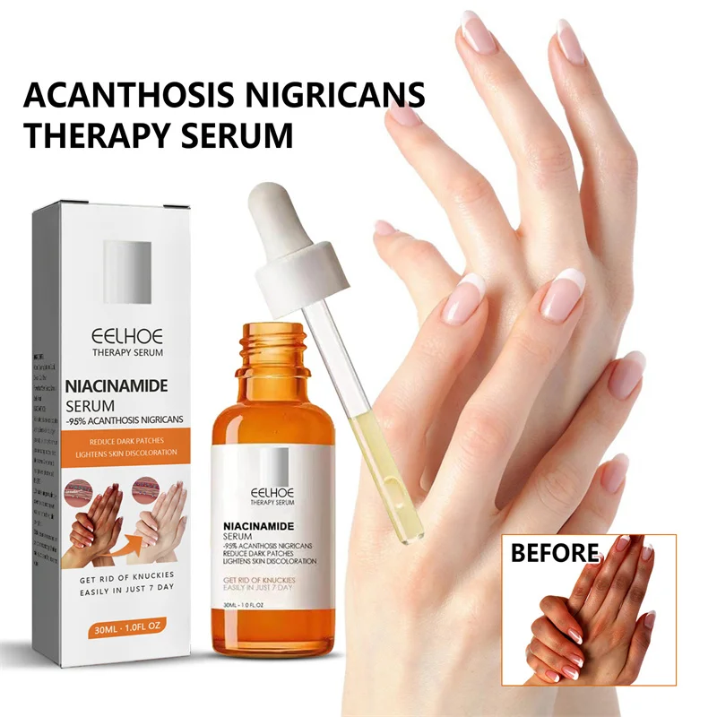 Dark Knuckles Fast Whitening Serum Pigmentation Correctors for Black Skin Hand Knuckle Elbows Knee Intense Stains Remover Serum
Dark Knuckles Fast Whitening Serum Pigmentation Correctors for Black Skin Hand Knuckle Elbows Knee Intense Stains Remover Serum
