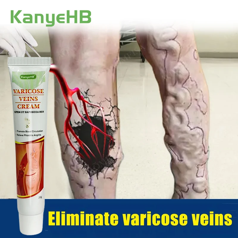 1Pcs Effective Varicose Vein Relief Cream Ointment For Varicose Veins To Relieve Vasculitis Phlebitis Spider Pain Treatment G002
1Pcs Effective Varicose Vein Relief Cream Ointment For Varicose Veins To Relieve Vasculitis Phlebitis Spider Pain Treatment G002