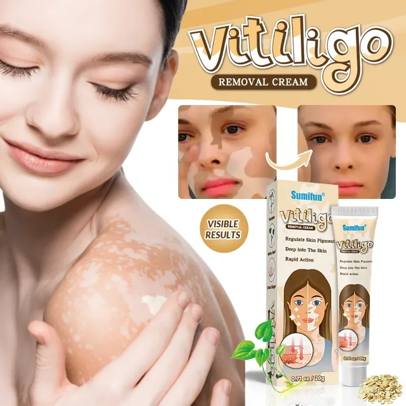 Vitiligo Cream Reduce White Spots Melanin Deposits Repair Skin Leukoplakia Disease Relieve Skin Itch Herbal Ointment Care 20g
Vitiligo Cream Reduce White Spots Melanin Deposits Repair Skin Leukoplakia Disease Relieve Skin Itch Herbal Ointment Care 20g