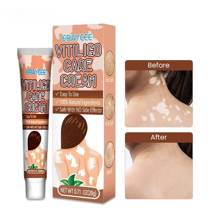 Herbal Extract Vitiligo Ointment Effectively Remove Ringworm White Spot Removal Skin Vitiligo Eliminate Vitiligo Treatment Cream
Herbal Extract Vitiligo Ointment Effectively Remove Ringworm White Spot Removal Skin Vitiligo Eliminate Vitiligo Treatment Cream