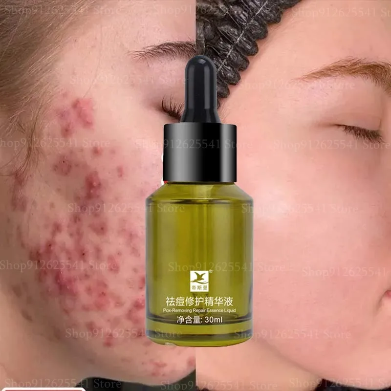 Acne Removing Repairing Face Serum Anti Pimples Spots Scars Removal Essence Shrink Pores Oil Control Repair Skin Care Products
Acne Removing Repairing Face Serum Anti Pimples Spots Scars Removal Essence Shrink Pores Oil Control Repair Skin Care Products