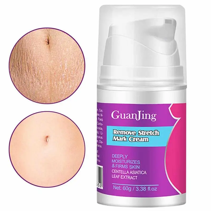 Stretch Mark Cream Pregnancy Cream For Belly Enhanced Elasticity And Compactness Prevent And Fade Belly Lines And Pigmentation
Stretch Mark Cream Pregnancy Cream For Belly Enhanced Elasticity And Compactness Prevent And Fade Belly Lines And Pigmentation
