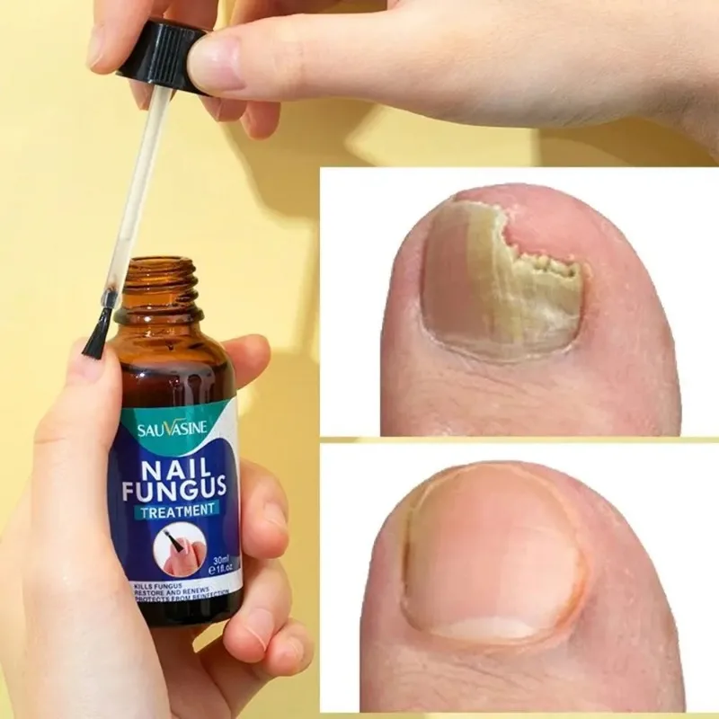 30ml Professional Nail Fungus Treatment Anti Infection Ingrown Essence Nail Drops Nail Treatment Essence Toenail Correction
30ml Professional Nail Fungus Treatment Anti Infection Ingrown Essence Nail Drops Nail Treatment Essence Toenail Correction