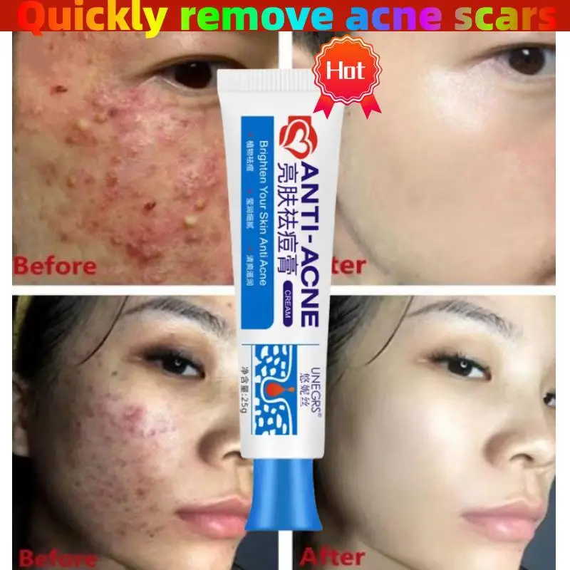 

Original Powerful Acne Removal Face Cream Clears Pimple Scar Black Dots Treat Severe Acne Shrink Pore Whiten Skin Care Ointment