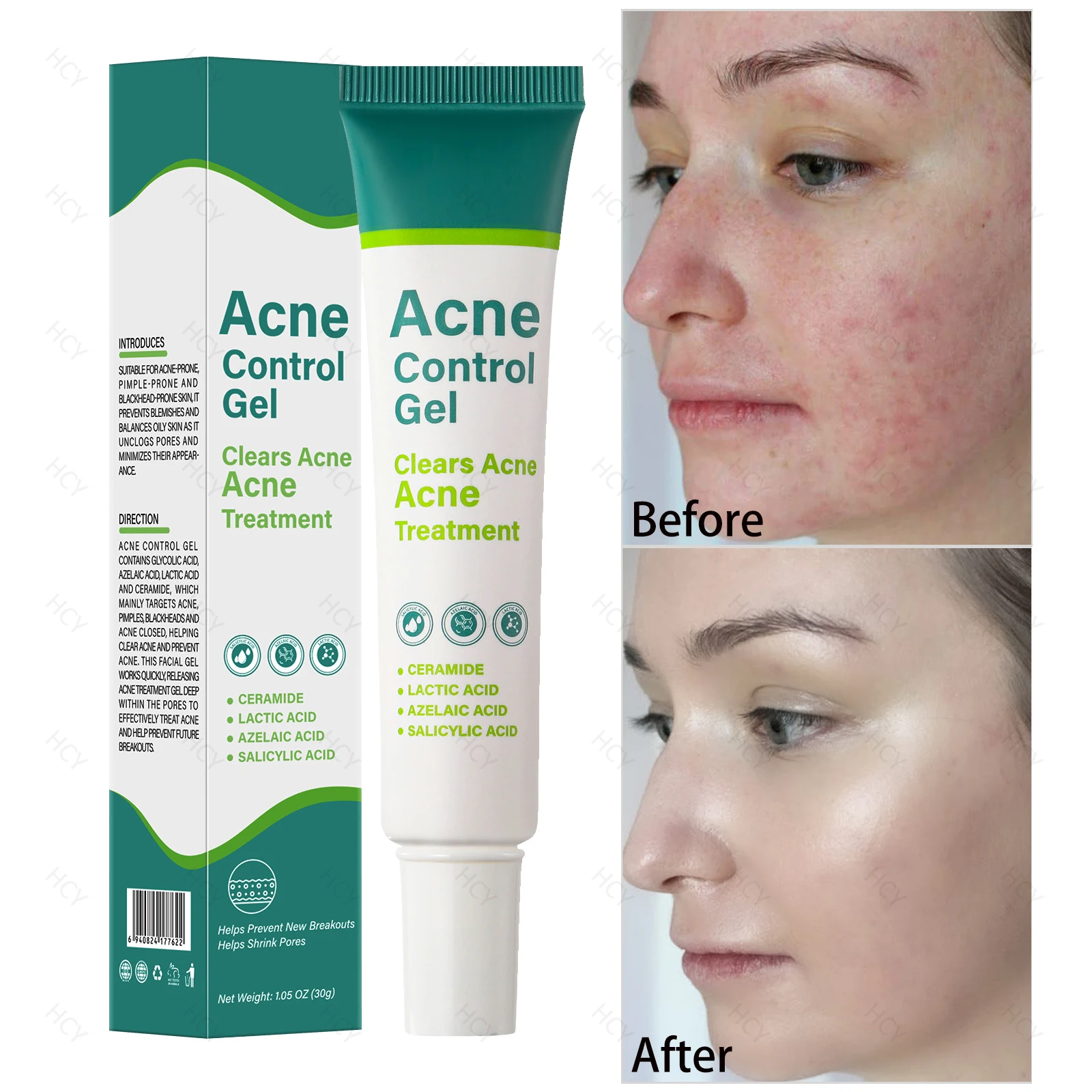 Salicylic Acid Acne Treatment Cream Repair Large Open Pore Removal Black Dots Blackhead Acne Moisturizer Whitening Skin Care
Salicylic Acid Acne Treatment Cream Repair Large Open Pore Removal Black Dots Blackhead Acne Moisturizer Whitening Skin Care