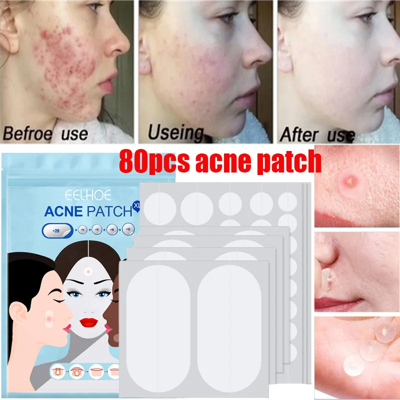 

36/80pcs Acne Pimple Sticker Invisible Hydrocolloid Acne Removal Treatment Patch Waterproof Black Head Remover Facial Skin Care