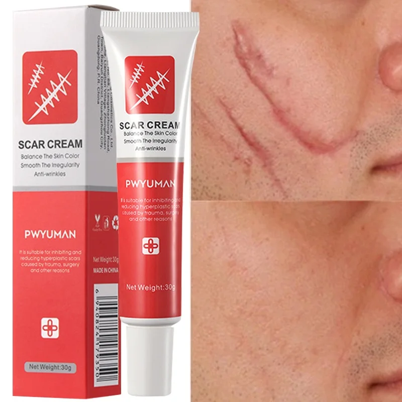 Effective Scar Removal Cream Remove New Old Scars Acne Marks Treatment Stretch Marks Burn Surgical Scar Repair Cream Skin Care
Effective Scar Removal Cream Remove New Old Scars Acne Marks Treatment Stretch Marks Burn Surgical Scar Repair Cream Skin Care