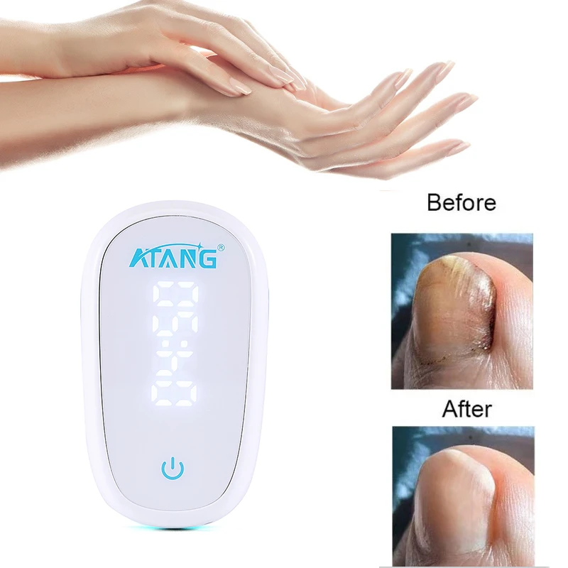 Nail Fungus Laser Therapy Onychomycosis Painless Toenails Onychomycosis Cure Machine for Fingernails Health
Nail Fungus Laser Therapy Onychomycosis Painless Toenails Onychomycosis Cure Machine for Fingernails Health