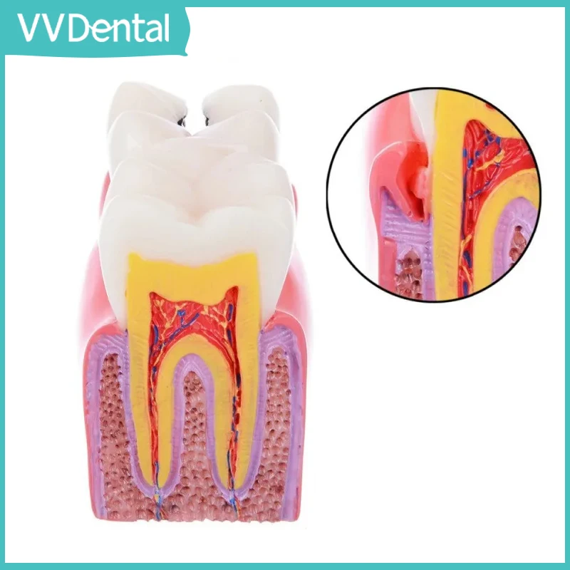 6 Times Dental Caries Comparsion Models Dental Teaching Model For Dental Study Teaching Dental Anatomy Endodontics Education
6 Times Dental Caries Comparsion Models Dental Teaching Model For Dental Study Teaching Dental Anatomy Endodontics Education
