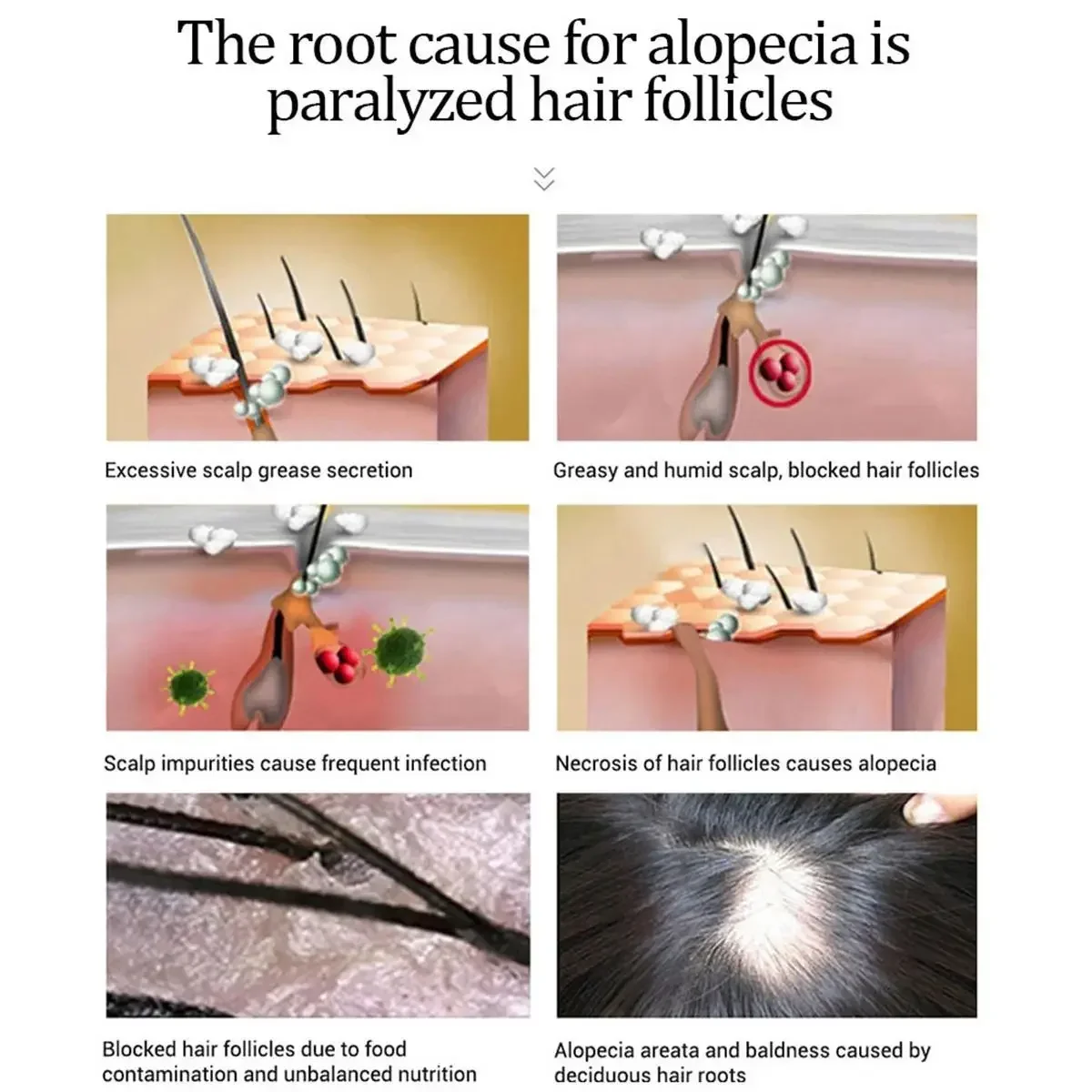 Sdottor Сыворотка для роста волос против выпадения волос Alopecia жидкий восстановление поврежденных волос быстрее растущий
Sdottor Сыворотка для роста волос против выпадения волос Alopecia жидкий восстановление поврежденных волос быстрее растущий