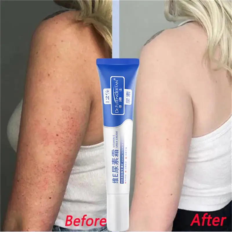 Восстанавливающий Лечебный крем для куриного фолликула, кератоза Pilaris, удаление темных пятен тела, глубокое увлажнение, разглаживание, уход за кожей 
Восстанавливающий Лечебный крем для куриного фолликула, кератоза Pilaris, удаление темных пятен тела, глубокое увлажнение, разглаживание, уход за кожей