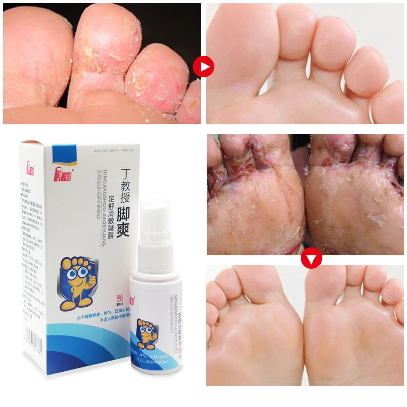Antifungal Athlete's Foot Itching Spray Herba Beriberi Anti-Itch Cream Toe Lnfections Peeling Treatment Deodorant Feet Care
Antifungal Athlete's Foot Itching Spray Herba Beriberi Anti-Itch Cream Toe Lnfections Peeling Treatment Deodorant Feet Care